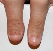 180px-Clubbed_Thumb_1.jpg